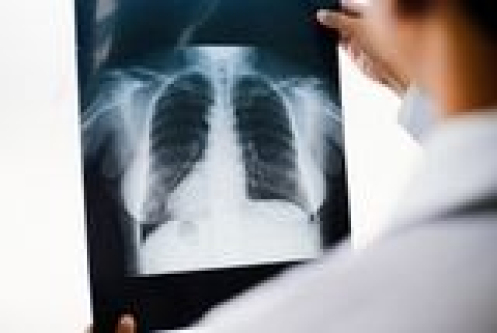 People With Lung Cancer Had Higher Levels of Microplastics in Their Lungs