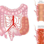 GLP-1 Meds Linked to Symptomatic Remission in UC