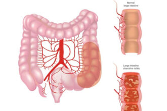 GLP-1 Meds Linked to Symptomatic Remission in UC