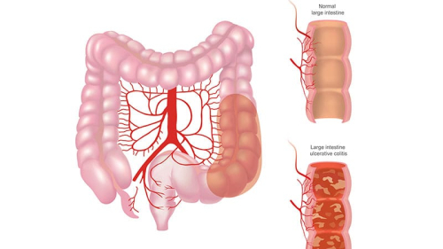 GLP-1 Meds Linked to Symptomatic Remission in UC