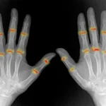 Some joints may be primed for rheumatoid arthritis before birth