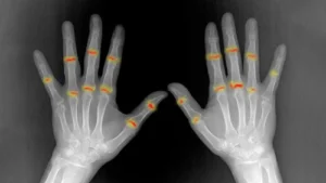 Some joints may be primed for rheumatoid arthritis before birth