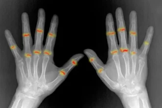 Some joints may be primed for rheumatoid arthritis before birth