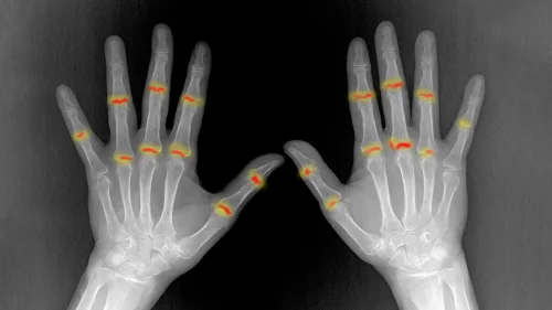 Some joints may be primed for rheumatoid arthritis before birth