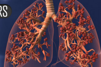 More Evidence Ties Microplastics to Lung Cancer