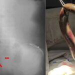 Diagnostic dilemma: Fisher’s colon punctured by eel that snuck in through his rectum