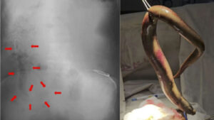 Diagnostic dilemma: Fisher’s colon punctured by eel that snuck in through his rectum