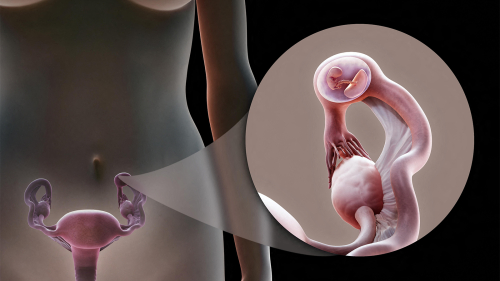 Ectopic Pregnancy Deaths Have Nearly Doubled. It’s Worse in Abortion-Ban States.