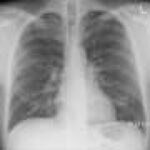 Trial shows risvutatug rezetecan significantly improves overall survival in relapsed small-cell lung cancer