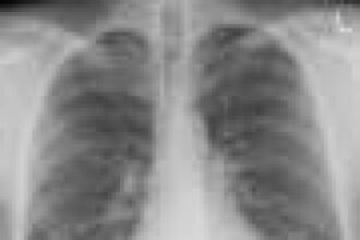Trial shows risvutatug rezetecan significantly improves overall survival in relapsed small-cell lung cancer