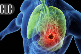 Local Consolidative Therapy After Dual Immunotherapy Fizzles in Metastatic NSCLC