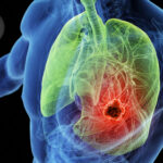 Significant Survival Boost With Novel ADCs  in Relapsed Small-Cell Lung Cancer