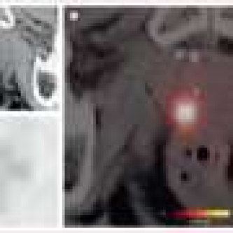 Prostate cancer: Specialized imaging could prevent unnecessary biopsies