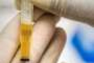 Simple urine test could guide kidney-protective treatment choices in type 2 diabetes