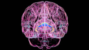 Brain Disorder Due to Vitamin Deficiency Often Goes Unrecognized