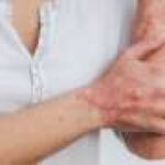 Big data analysis sheds light on psoriasis’s genetic code