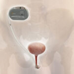 Remote-Controlled Urinary Sphincter Could Transform Incontinence Treatment for Men