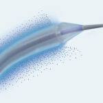 Selution SLR Drug-Eluting Balloon Gets FDA Nod for Coronary In-Stent Restenosis