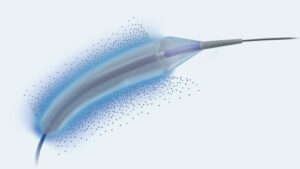Selution SLR Drug-Eluting Balloon Gets FDA Nod for Coronary In-Stent Restenosis